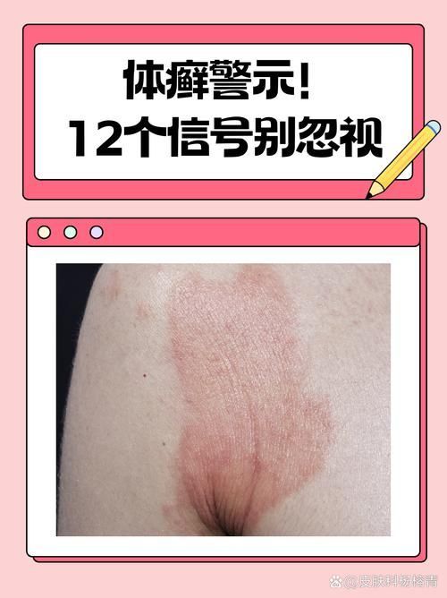 真菌和細菌感染的治療方法有哪些，真菌與細菌感染的區別