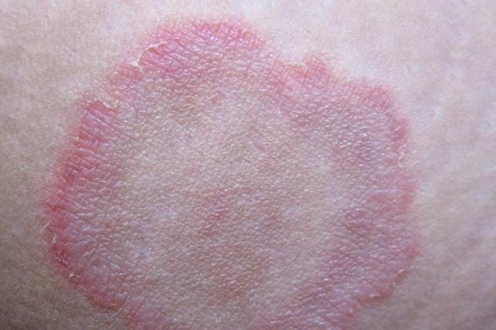 真菌和細菌感染的治療方法有哪些，真菌與細菌感染的區別