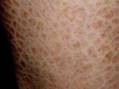 如何預防立鱗病的傳染，關于錦鯉立鱗病