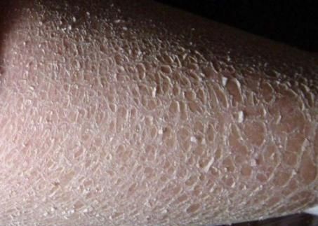 如何預防立鱗病的傳染，關于錦鯉立鱗病