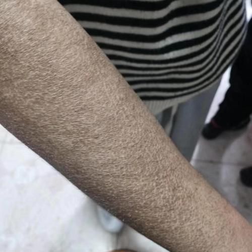 如何預防立鱗病的傳染，關于錦鯉立鱗病