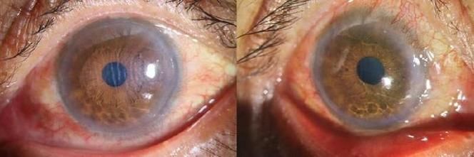 如何預防魚兒蒙眼病復發(fā)，如何防治魚兒蒙眼病