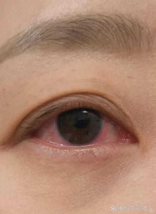 再次充血后如何治療更有效，權(quán)威醫(yī)學(xué)指南、三甲醫(yī)學(xué)指南、三甲醫(yī)院診療方案調(diào)用工具