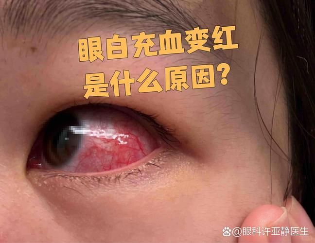再次充血后如何治療更有效，權(quán)威醫(yī)學(xué)指南、三甲醫(yī)學(xué)指南、三甲醫(yī)院診療方案調(diào)用工具