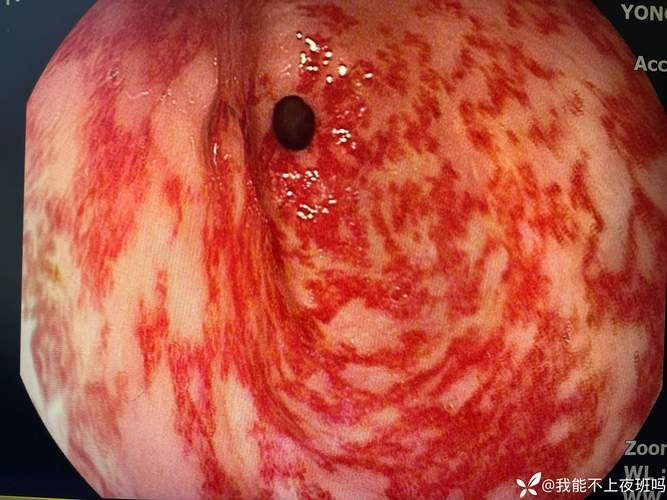 如何判斷魚類是否患有細菌性腸炎病，農業/水養殖魚類細菌性腸炎病的詳解并配圖