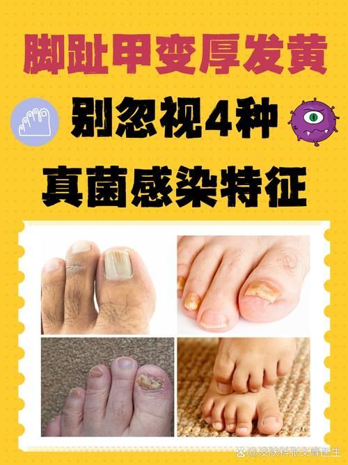 如何預防深部真菌感染，關于深部真菌感染預防 如何預防深部真菌感染，關于深部真菌感染預防 龍魚百科 第5張