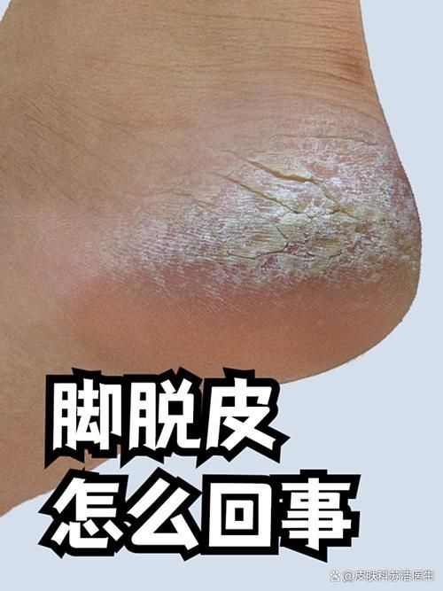 如何預防深部真菌感染，關于深部真菌感染預防 如何預防深部真菌感染，關于深部真菌感染預防 龍魚百科 第4張