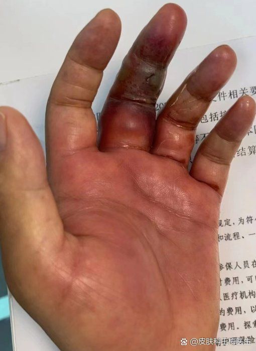 海洋創傷弧菌感染有哪些治療方法，創傷弧菌感染如何治療