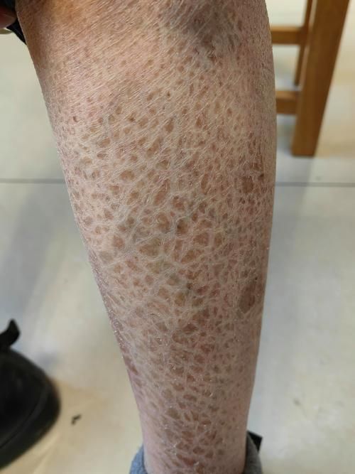 如何預防魚炸鱗病的發生