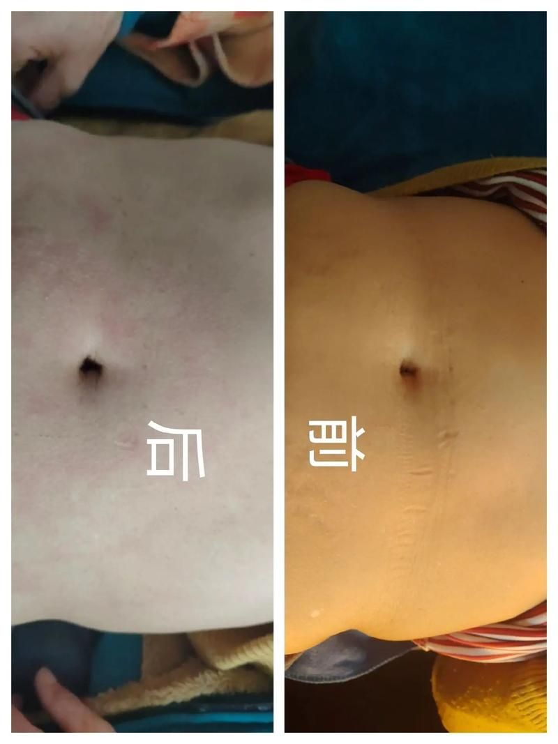 如何判斷魚腹水是否好轉(zhuǎn)，如何判斷腹水好轉(zhuǎn) 如何判斷魚腹水是否好轉(zhuǎn)，如何判斷腹水好轉(zhuǎn) 龍魚百科 第4張