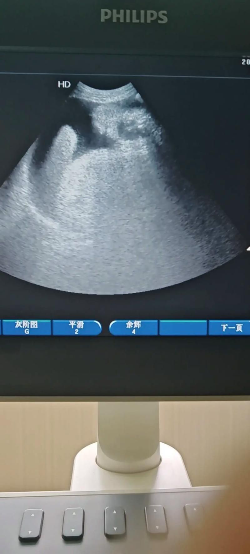 如何判斷魚腹水是否好轉(zhuǎn)，如何判斷腹水好轉(zhuǎn) 如何判斷魚腹水是否好轉(zhuǎn)，如何判斷腹水好轉(zhuǎn) 龍魚百科 第1張