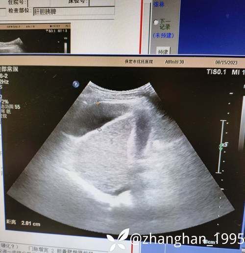 如何判斷腹水是否復發(fā)，****臨床診斷標準、腹水復發(fā)的判斷指標 如何判斷腹水是否復發(fā)，****臨床診斷標準、腹水復發(fā)的判斷指標 龍魚百科 第4張