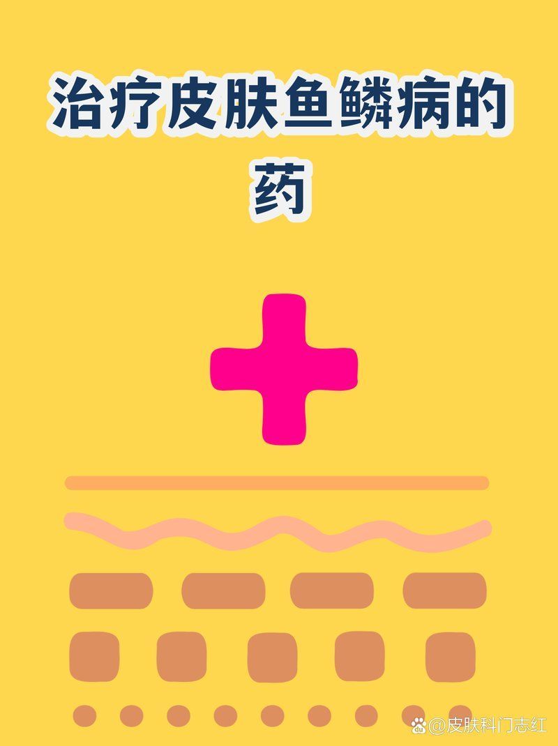 哪種藥物對魚鱗病最有效，治療魚鱗病的藥物