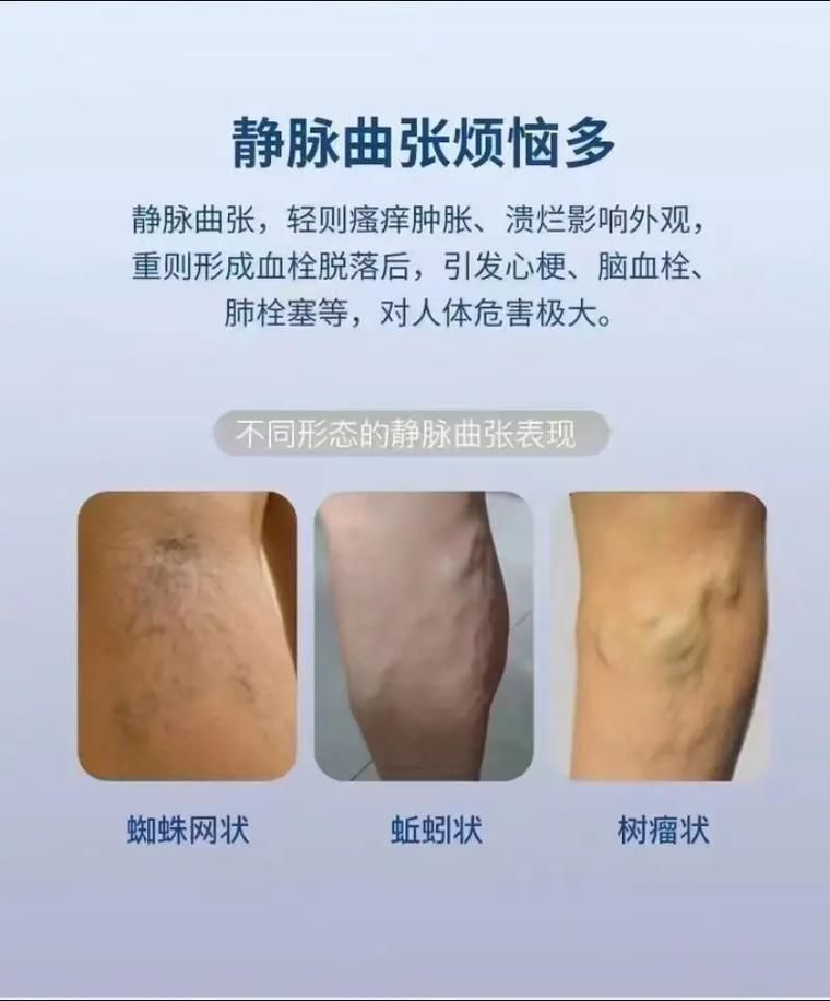 有沒有更多關于病理性膨脹的設定，“病理性膨脹”是什么意思？ 有沒有更多關于病理性膨脹的設定，“病理性膨脹”是什么意思？ 龍魚百科 第15張