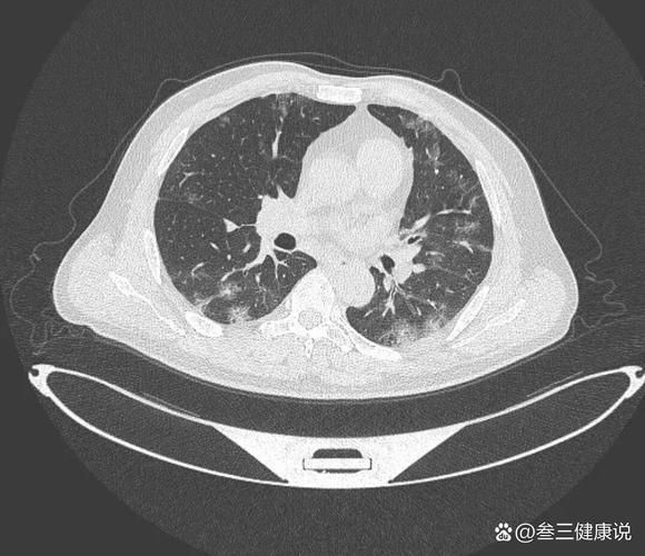 如何判斷自己是否感染了交叉病原體，交叉病原體感染指同一宿主同時(shí)或先后感染了交叉病原體 如何判斷自己是否感染了交叉病原體，交叉病原體感染指同一宿主同時(shí)或先后感染了交叉病原體 龍魚(yú)百科 第6張