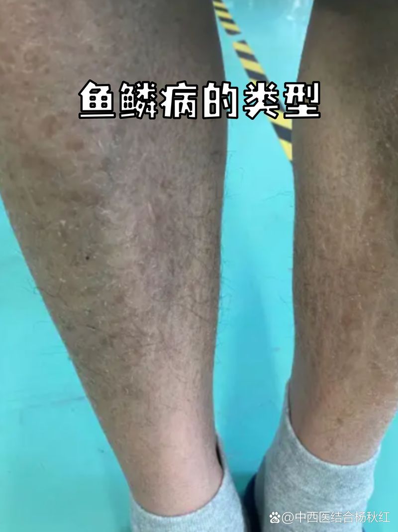 人類的魚鱗病有哪些類型，如何判斷魚鱗病？ 人類的魚鱗病有哪些類型，如何判斷魚鱗病？ 龍魚百科 第3張
