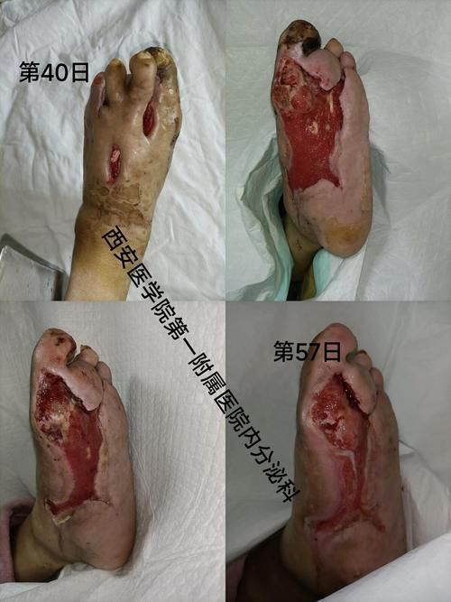 能提供更多潰爛病的圖片嗎，常見潰爛病的癥狀對比表