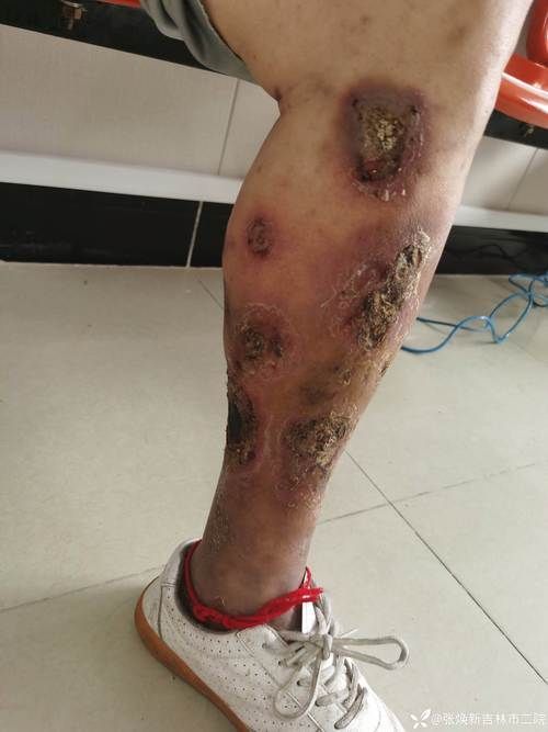 能提供更多潰爛病的圖片嗎，常見潰爛病的癥狀對比表