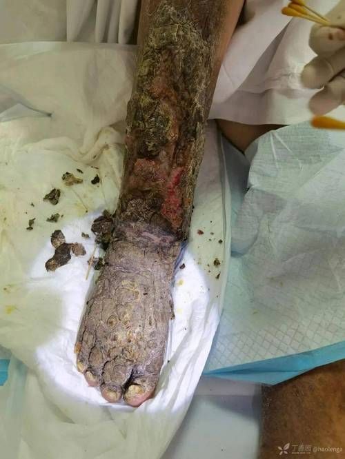 能提供更多潰爛病的圖片嗎，常見潰爛病的癥狀對比表