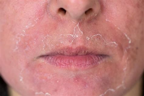 龍魚嘴脫皮后如何恢復正常飲食？，龍魚嘴脫皮后如何恢復正常飲食 龍魚嘴脫皮后如何恢復正常飲食？，龍魚嘴脫皮后如何恢復正常飲食 斯巴沃紅龍魚 第2張