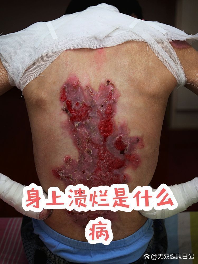 爛身病有哪些癥狀，爛身病，也被稱為皮膚感染或皮膚疾病，是一種常見的健康問題