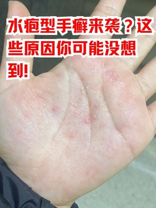 有哪些手部真菌感染的常見誤區，手部真菌感染（手上長癬）的常見誤區