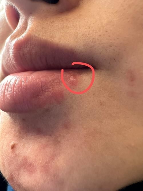 如何治療魚嘴凸起白色包，如何治療魚嘴凸起白色凸起性淡黃 如何治療魚嘴凸起白色包，如何治療魚嘴凸起白色凸起性淡黃 龍魚百科 第5張