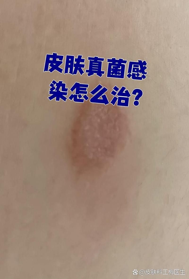 哪種方法對真菌最有效，口服抗真菌藥物聯合外用藥物聯合外用藥物治療真菌最有效 哪種方法對真菌最有效，口服抗真菌藥物聯合外用藥物聯合外用藥物治療真菌最有效 龍魚百科 第1張