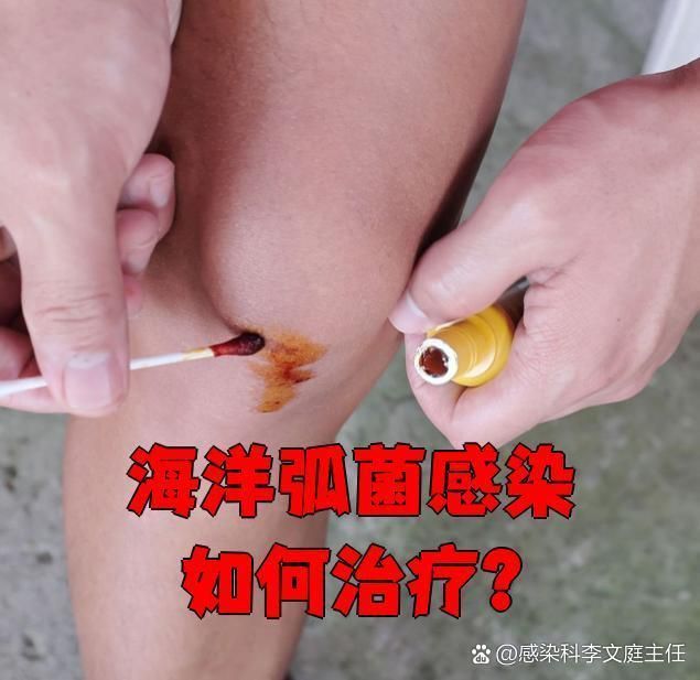 感染海水細菌后如何治療，中的“海水細菌”→創傷弧菌 感染海水細菌后如何治療，中的“海水細菌”→創傷弧菌 龍魚百科 第4張