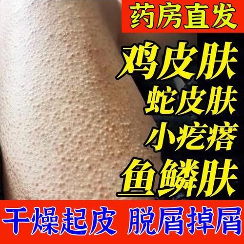 有哪些保濕產(chǎn)品適合魚鱗病患者