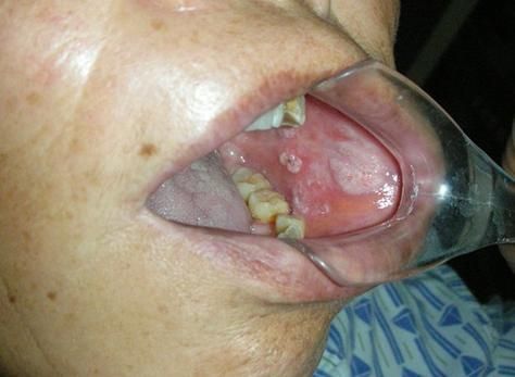 如何區分龍魚嘴巴的良性與惡性腫瘤?,如何區分龍魚嘴巴的良性與惡性腫瘤并明確要求1000字說明和配圖 龍魚百科 第4張 如何區分龍魚嘴巴的良性與惡性腫瘤?,如何區分龍魚嘴巴的良性與惡性腫瘤并明確要求1000字說明和配圖 如何區分龍魚嘴巴的良性與惡性腫瘤?,如何區分龍魚嘴巴的良性與惡性腫瘤并明確要求1000字說明和配圖 龍魚百科 第4張