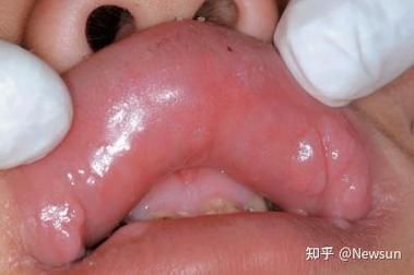 如何區分龍魚嘴巴的良性與惡性腫瘤?,如何區分龍魚嘴巴的良性與惡性腫瘤并明確要求1000字說明和配圖 龍魚百科 第2張 如何區分龍魚嘴巴的良性與惡性腫瘤?,如何區分龍魚嘴巴的良性與惡性腫瘤并明確要求1000字說明和配圖 如何區分龍魚嘴巴的良性與惡性腫瘤?,如何區分龍魚嘴巴的良性與惡性腫瘤并明確要求1000字說明和配圖 龍魚百科 第2張
