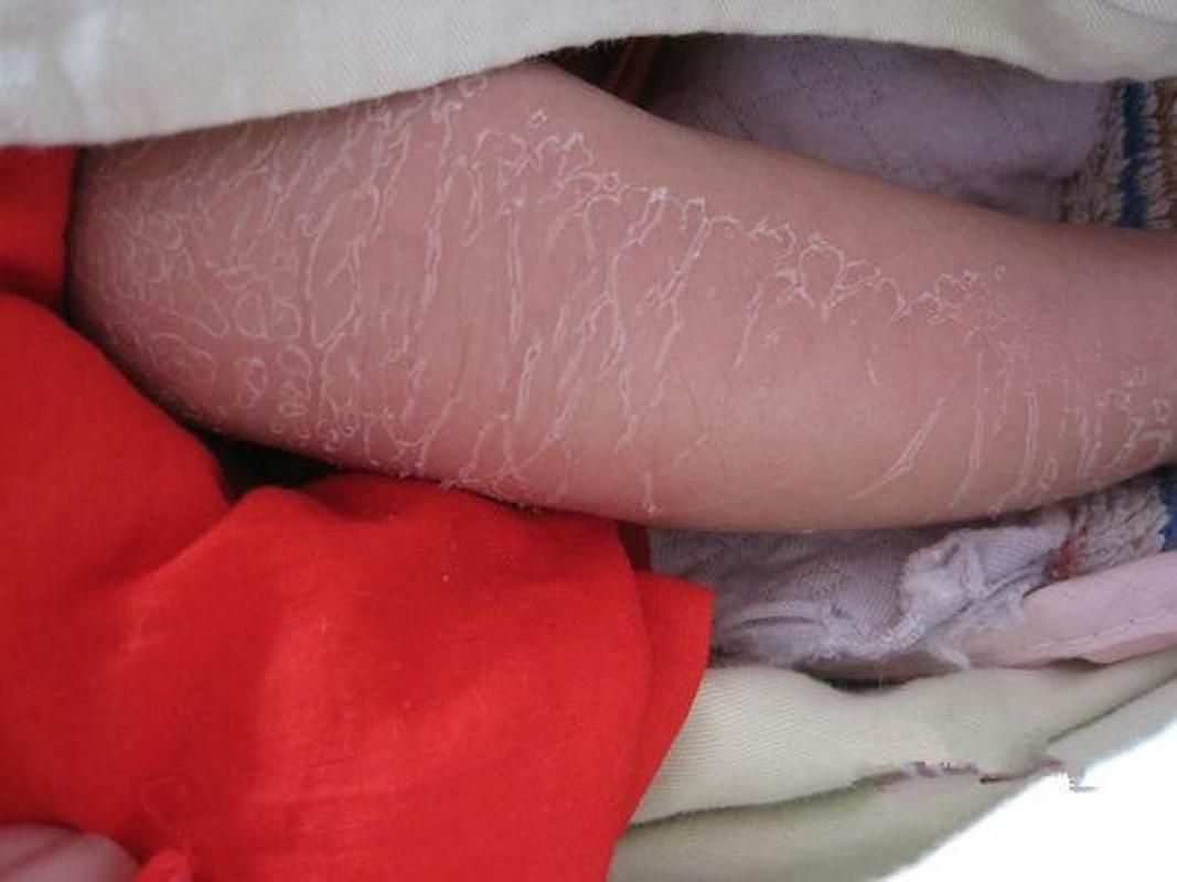有哪些藥物可以治療松鱗病，魚鱗病外用藥物搭配