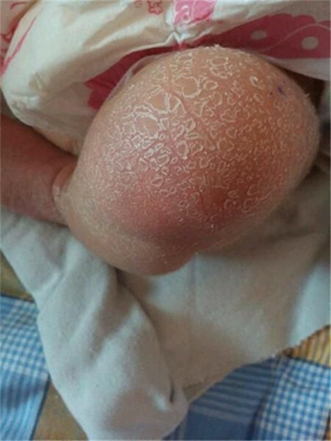 有哪些藥物可以治療松鱗病，魚鱗病外用藥物搭配