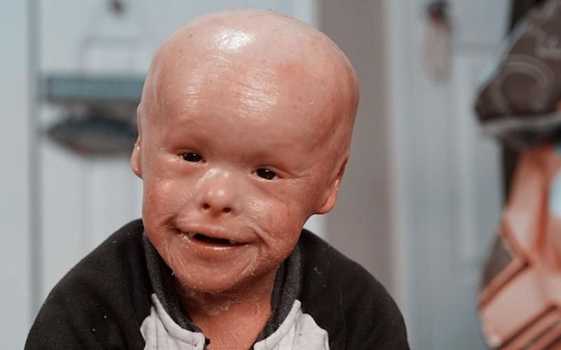 有哪些藥物可以治療松鱗病，魚鱗病外用藥物搭配