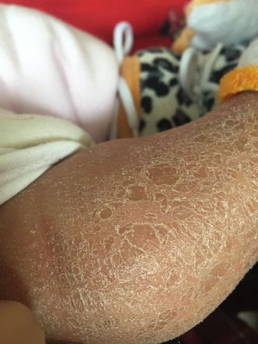 有哪些藥物可以治療松鱗病，魚鱗病外用藥物搭配