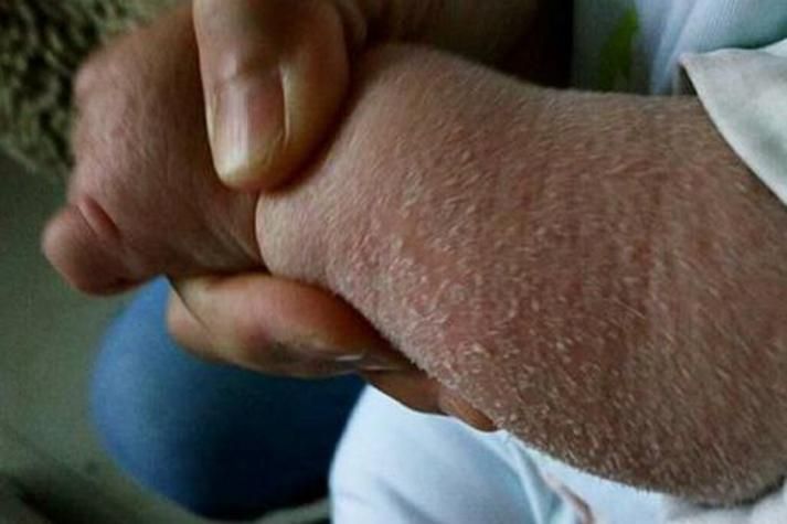 有哪些藥物可以治療松鱗病，魚鱗病外用藥物搭配