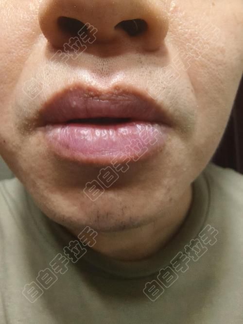 如何區分龍魚嘴上的肉球是腫瘤還是腫斑病？，如何區分龍魚嘴上的肉球是腫瘤還是腫斑病