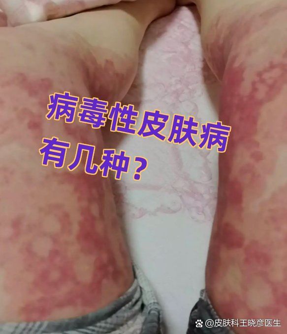 病毒性爛身病如何防控，如何防控病毒性爛身病