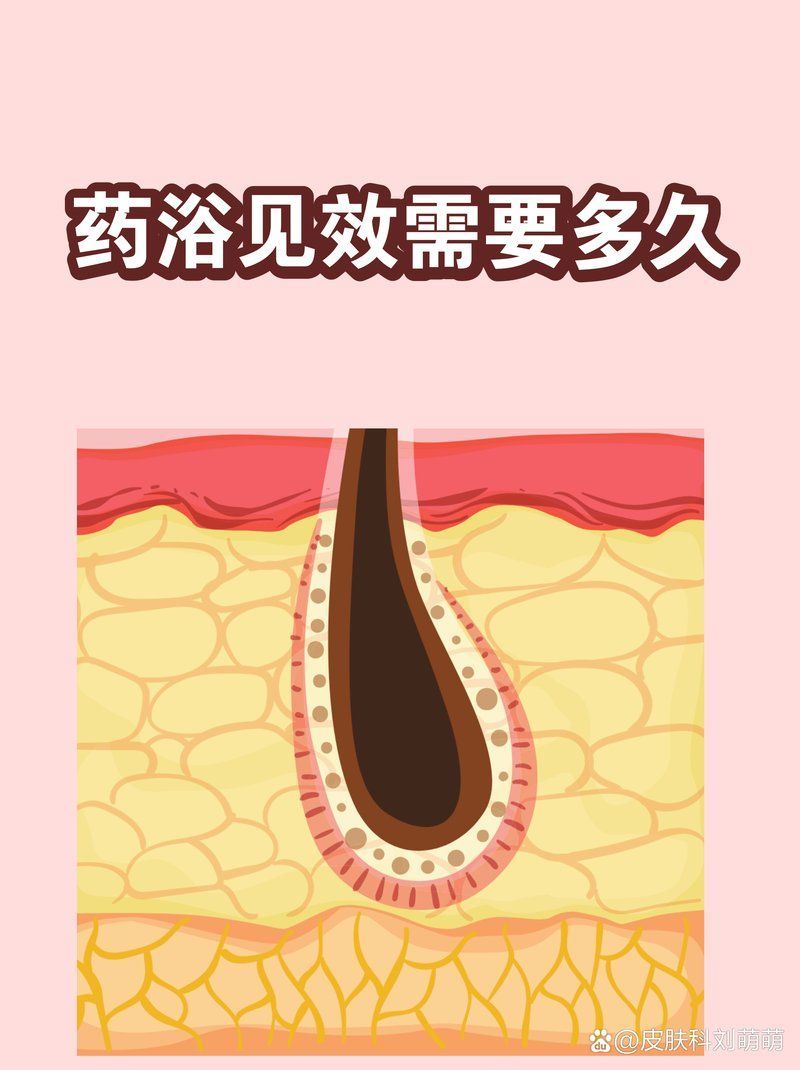 藥浴治療一般需要多長時間見效，藥浴治療期間需要多長時間見效，藥浴見效時間因人而異