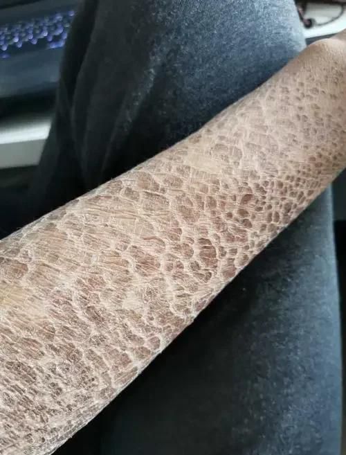 人類魚鱗病有哪些類型