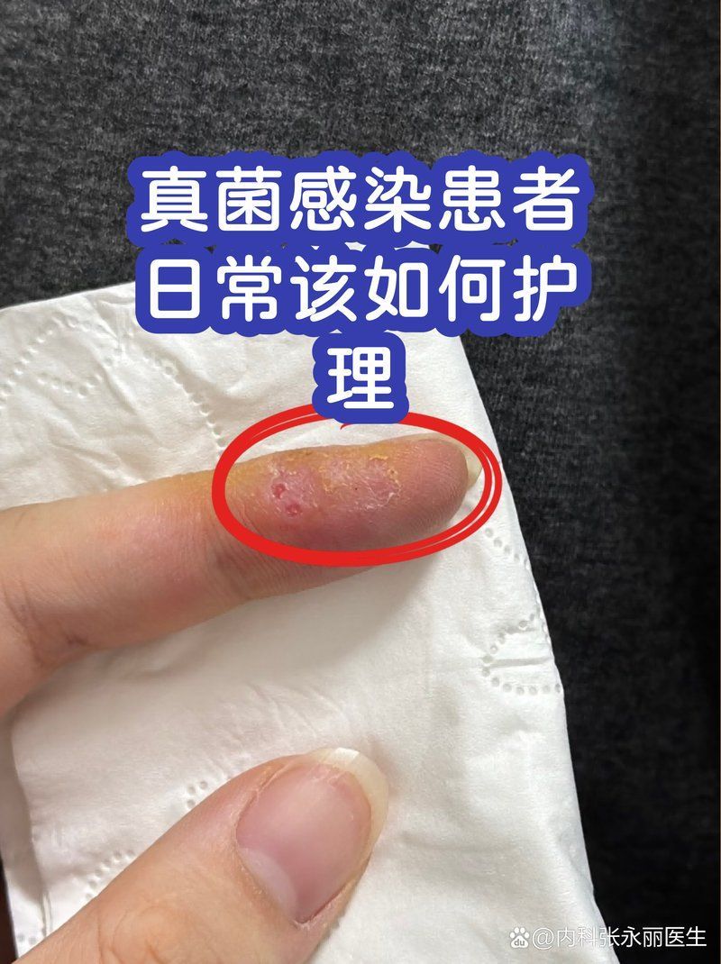 晚期真菌感染如何預防復發，晚期真菌感染的預防復發