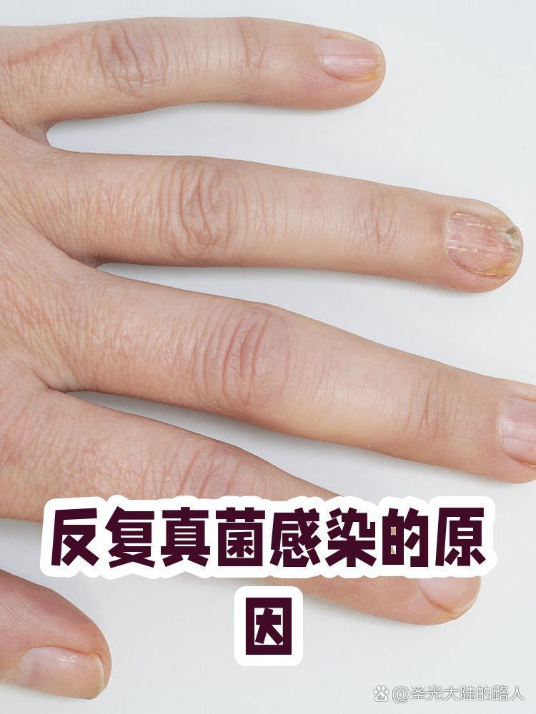 晚期真菌感染如何預防復發(fā)，晚期真菌感染的預防復發(fā)
