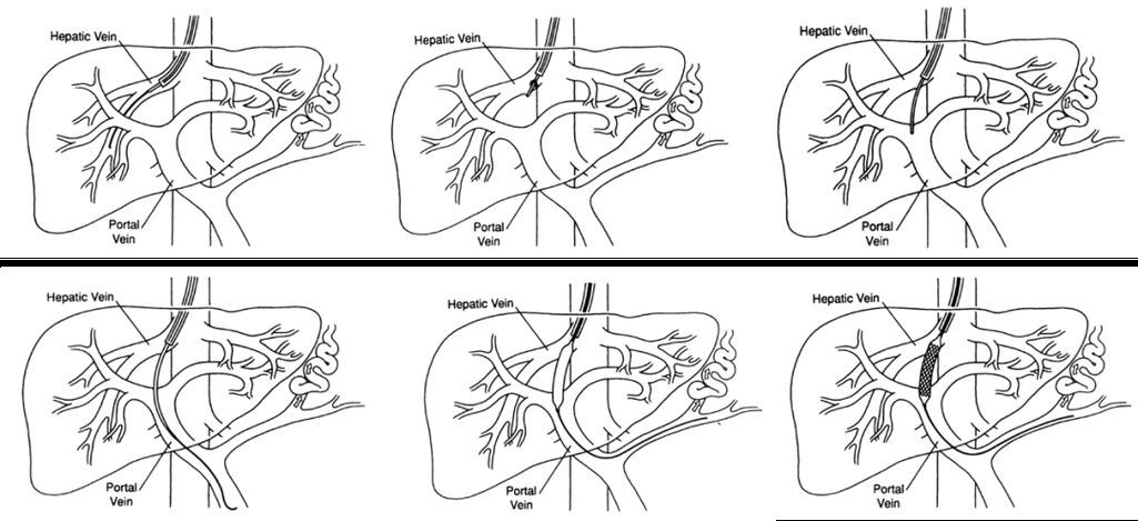 腹水病如何治療，干預腹水病治療