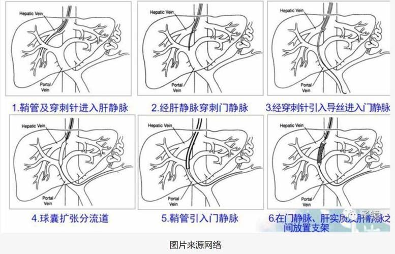 腹水病如何治療，干預腹水病治療