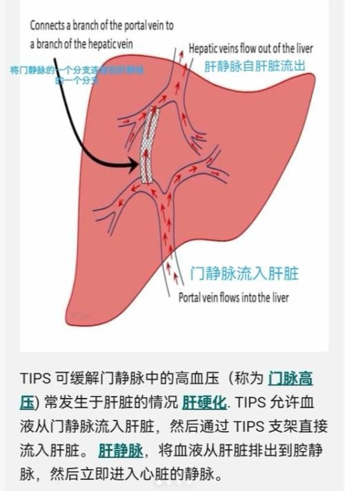 腹水病如何治療，干預腹水病治療