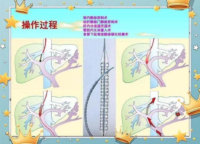 腹水病如何治療，干預腹水病治療