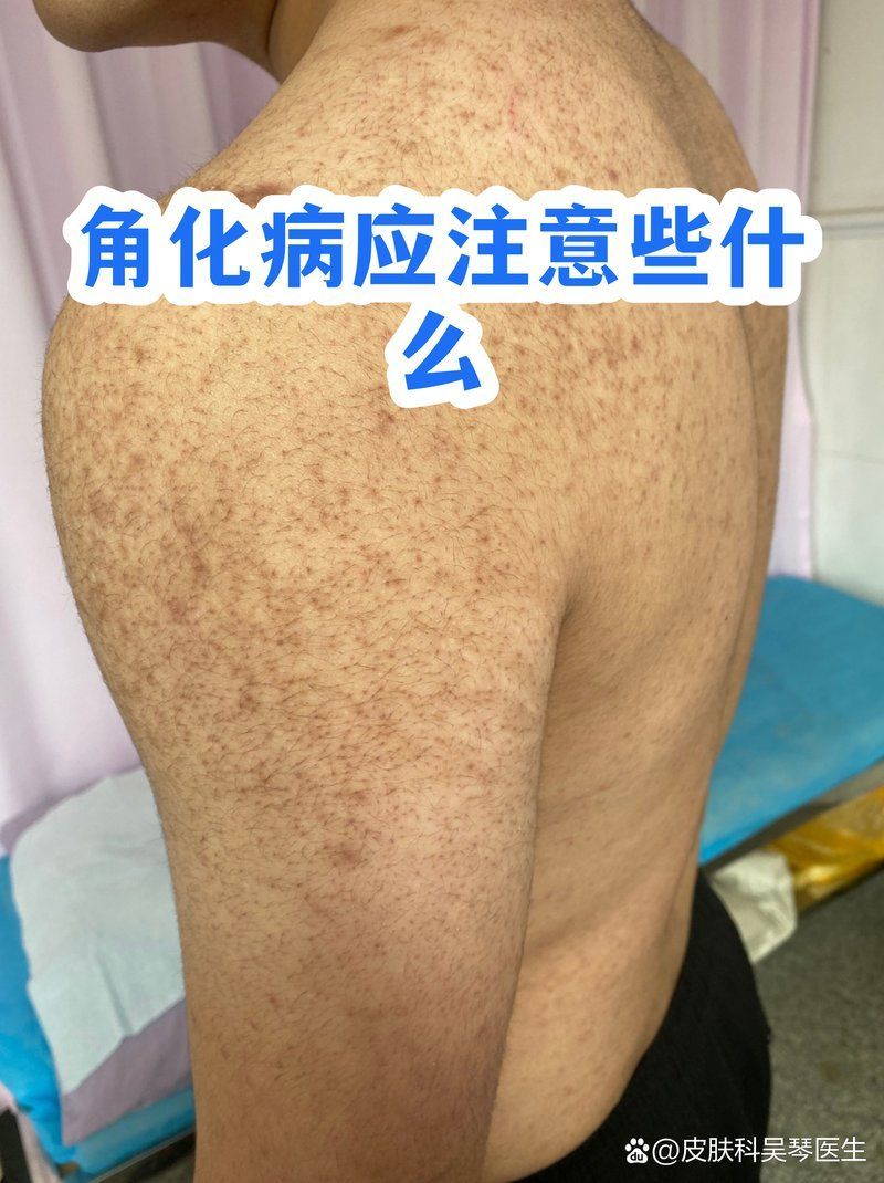炸鱗病康復后如何護理，關于炸鱗病（魚鱗病）康復后護理