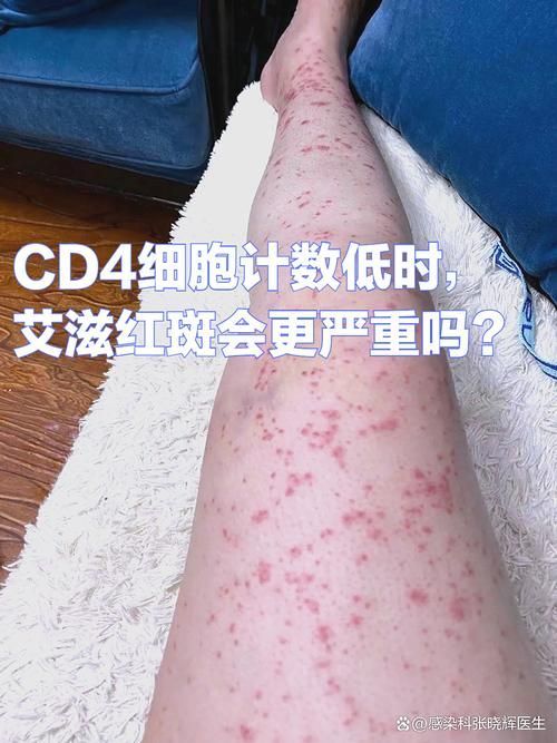 如何區(qū)分龍魚(yú)病和艾滋病？，如何區(qū)分“龍魚(yú)病”和“艾滋病” 如何區(qū)分龍魚(yú)病和艾滋病？，如何區(qū)分“龍魚(yú)病”和“艾滋病” 龍魚(yú)百科 第4張