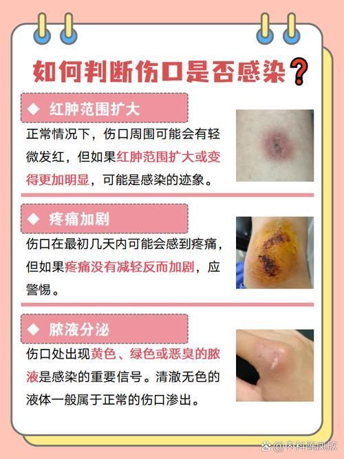 有哪些常見的交叉感染類型及其癥狀，交叉感染是什么？